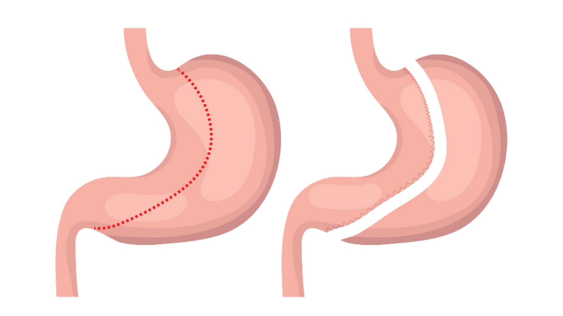 Preparing for Gastric Sleeve Surgery: Tips and Advice